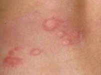 Kronik Kurdeşen Belirtileri ve Tedavisi