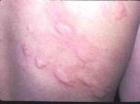 Ürtiker Kurdeşen Belirtileri ve Tedavisi